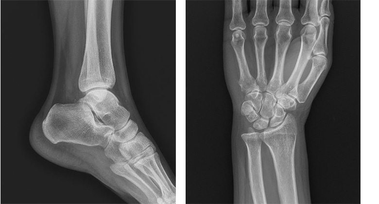 평판 검출기로 촬영한 발과 손목의 X-ray 영상 예시 발과 손목의 X-ray 영상 두 장