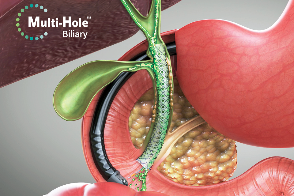 담도용 Multi-Hole 스텐트의 시술 적용 이미지 담도에 삽입된 Multi-Hole Biliary 스텐트와 내시경을 보여 주는 해부학적 시술 일러스트