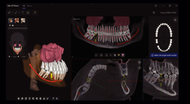 SMARTDent 3D의 임플란트 진단 및 시뮬레이션 화면 치과 CT 파노라마와 3D 치아 모델, 단면 뷰가 함께 표시된 SMARTDent 3D 화면
