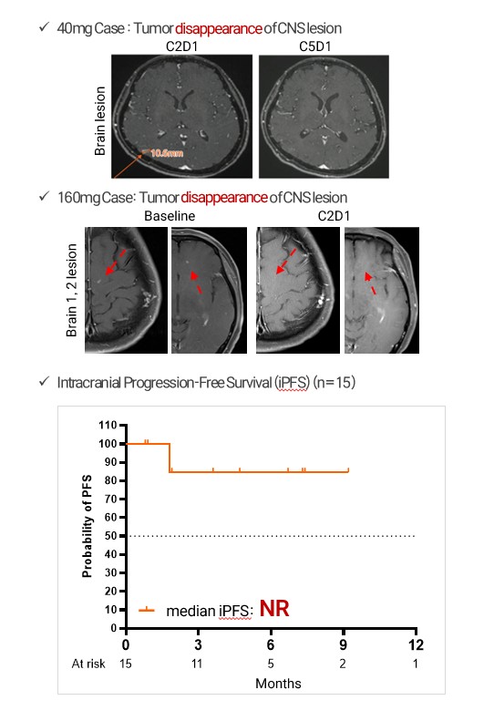 치료 전후 뇌 병변 MRI와 두개강 내 무진행생존 그래프 뇌 병변 MRI 비교 이미지와 두개강 내 무진행생존 그래프