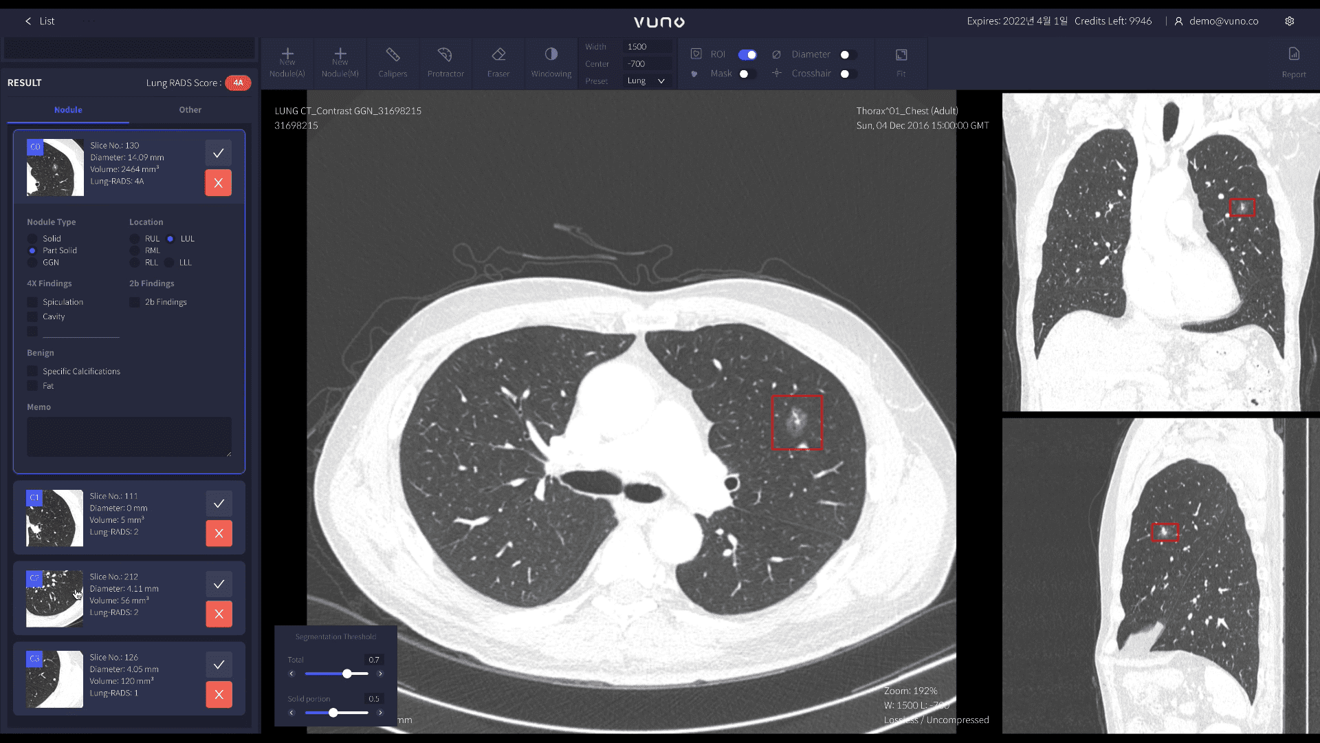 폐 CT 영상의 결절 후보를 표시한 VUNO Med-LungCT AI 화면 폐 CT 단면과 관상·시상면 영상에서 붉은 상자로 결절 후보를 표시한 VUNO 화면