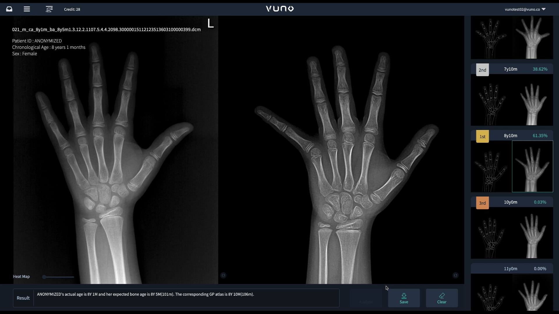 VUNO Med-BoneAge의 손 엑스레이 골연령 분석 화면 양손 엑스레이와 골연령 비교 결과가 표시된 VUNO Med-BoneAge 화면