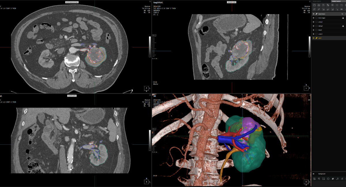CT 기반 신장·혈관 3D 모델링 화면 복부 CT 단면·다평면 영상과 신장 및 혈관의 3D 분할 모델을 함께 표시한 의료영상 소프트웨어 화면