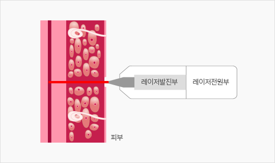 피부에 작용하는 레이저 발진부 구조 도식 피부 단면에 레이저 발진부와 레이저 전원부가 연결된 구조를 나타낸 도식